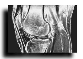 Магнитно-резонансная томография (МРТ) коленного сустава в аксиальной проекции (связки, мениск, суставной хрящ)